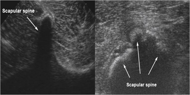 Photo: Ultrasound examination of the scapula (shoulder blade) may demonstrate thickening of the scapular spine or evidence of a fracture.