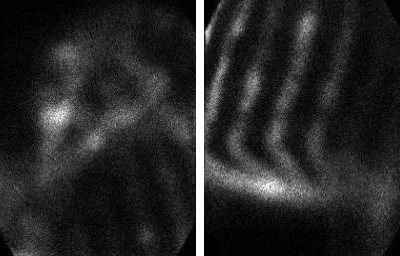 Photo: Bone scans are highly useful for verification of the widespread nature of the disease. Multiple abnormalities are identified in multiple bones of the upper portions of the legs, the vertebral spine, and the ribs.