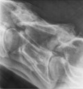 Photo: Diagnosis of Silicate Associated Osteoporosis (SAO) is confirmed by bone scans. The results of routine blood tests are usually normal. Radiographs of the legs are not generally helpful in disease diagnosis because the bones in the lower part of the limbs are minimally affected. Good quality radiographs of the lower cervical vertebrae in the base of the neck may be useful for detection of bone changes in moderately to severely affected horses.