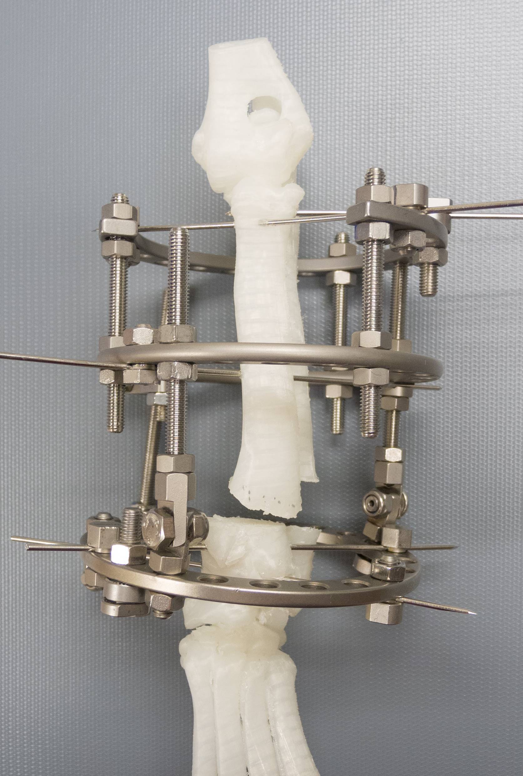 3D printed bone deformity correction