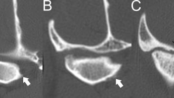 Photo: TMJ arthritis CT